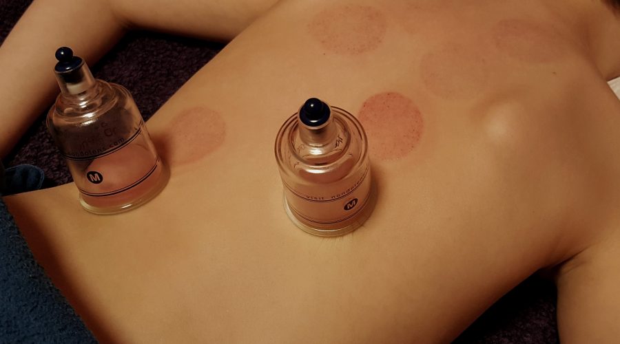 Cupping Treatment: The Essential Guide