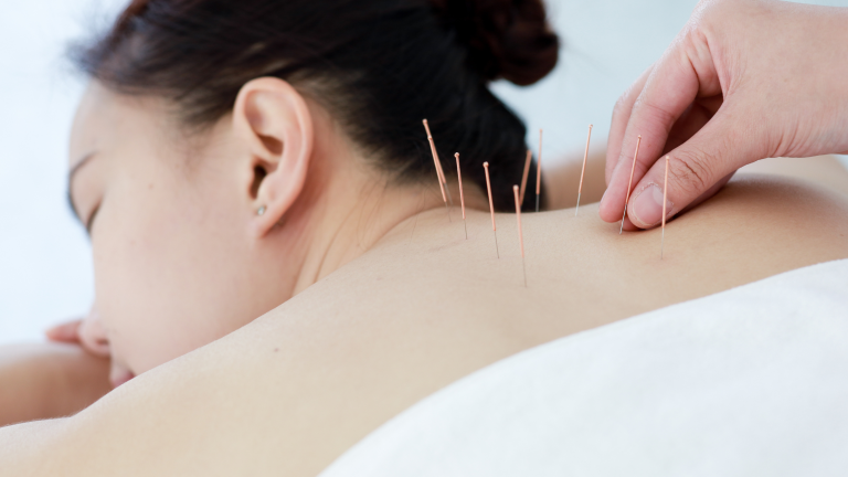 Acupuncture For Neck Pain: Angela’s Experience